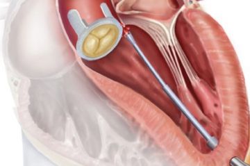 ترمیم دریچه قلب با استفاده از ابزارهای رباتیک